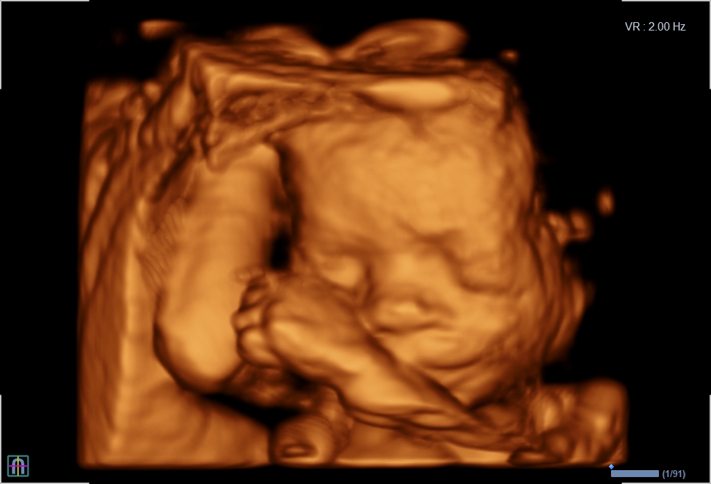 3D 4D Ultraschall Baby Ultraschallbild personalisiert Schwangerschaft Foto Sono 